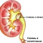 Камни в почках – сигнал проблем с сердцем