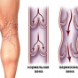 Врачи рассказали, чем опасна варикозная болезнь