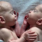 Сіамських близнючок роз'єднали під час ризикованої 4-годинної операції: фото