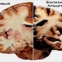 Знание иностранного языка отсрочивает болезнь Альцгеймера