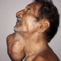 Фермер 20 лет откладывал поход к врачу и заработал опухоль размером с голову