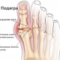 Подагра: виноваты гены