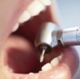 Стоматологи обещают прекратить сверлить зубы направо и налево
