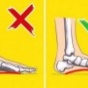 Медики подсказали, как вылечить плоскостопие