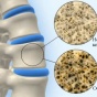 В организме нашли "лекарство" от остеопороза