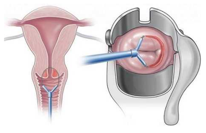 конизация шейки матки