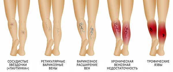 признаки варикозного расширения вен