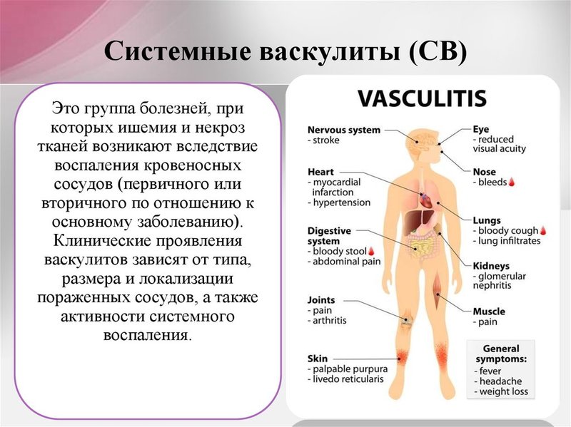 Васкулит: что нужно знать о воспалении сосудов