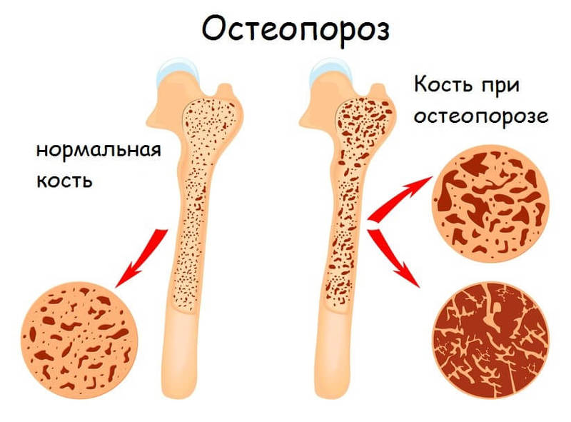 Как предотвратить остеопороз: ключ к крепким костям