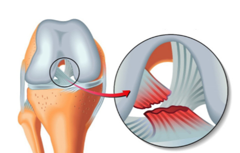 розірвана хрестоподібна зв'язка