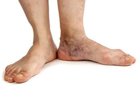 трофічна виразка