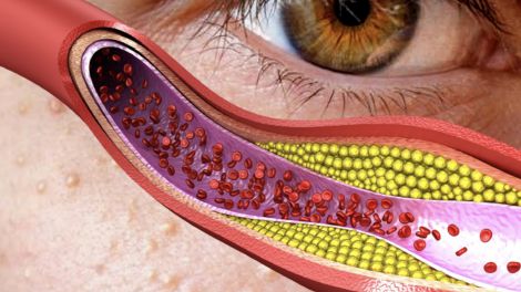 підвищений холестерин