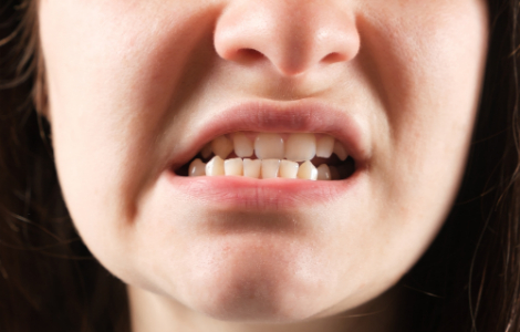 неправильний прикус