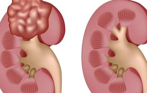 Поради для збереження здоров'я нирок у холодну пору року нирки
