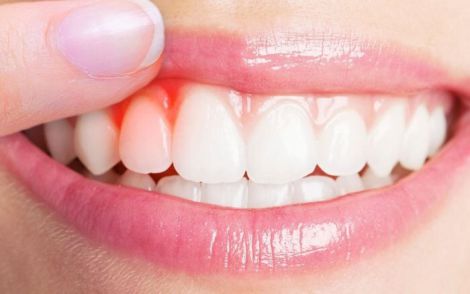 Ознаки, які свідчать про запалення навколо зубного імланта запалення