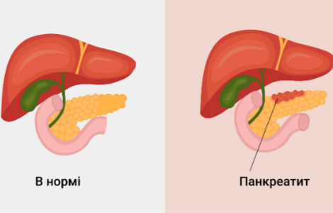 панкреатит