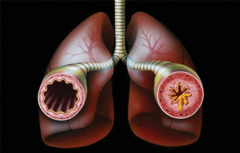 бронхіальна астма