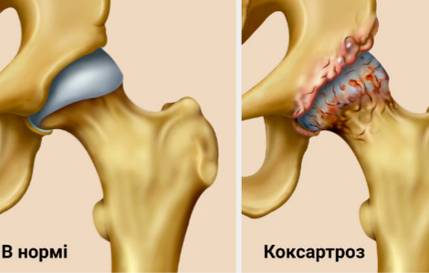 коксартроз