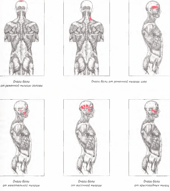Головная и лицевая боль: Триггерные точки