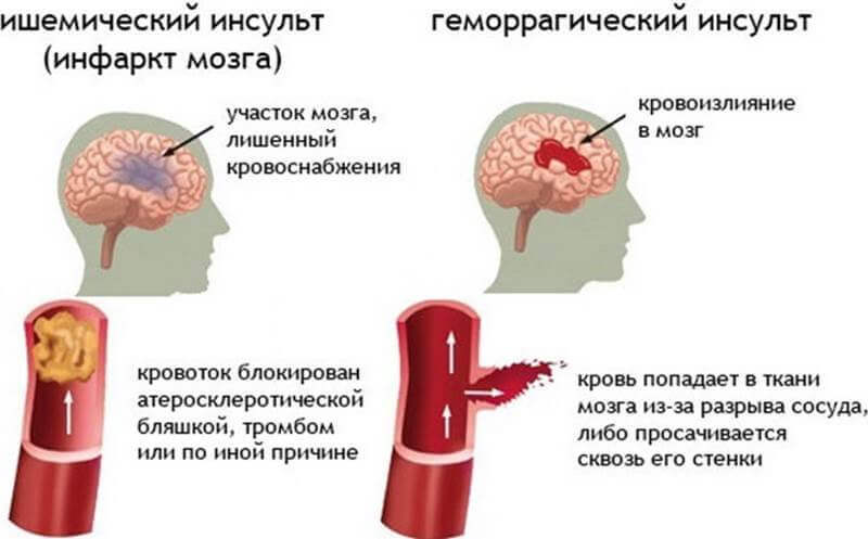 Инсульт: Первые признаки опасности