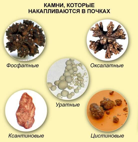 Нежелательные минералы: Камни в почках. Что делать?