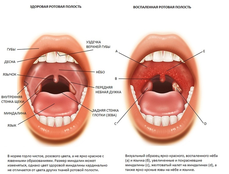 Ангина летом: 7 примет болезни, которые нельзя игнорировать!