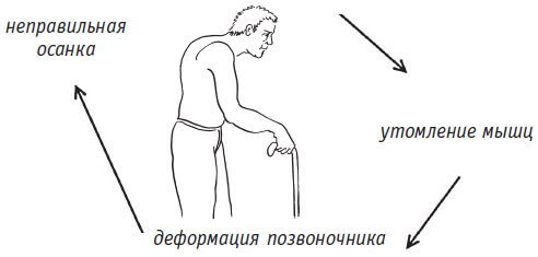 Неправильная осанка: хронический мышечный спазм