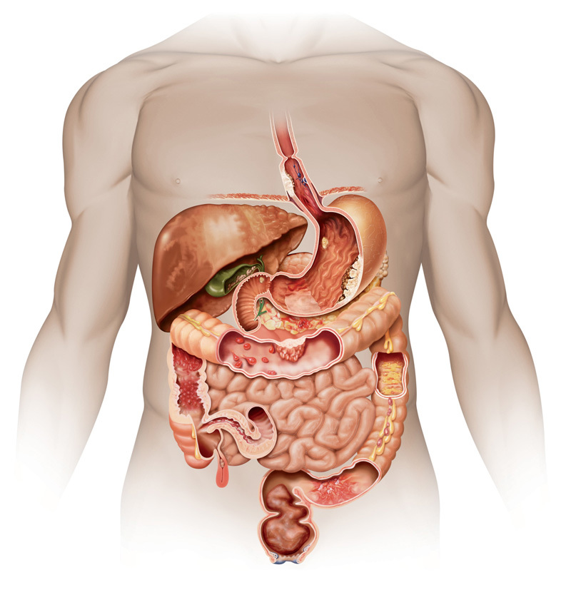 9 продуктів, які викликають в організмі хронічне запалення