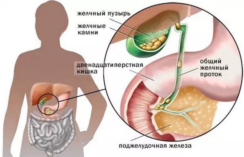 Камни в желчном: от чего возникают и как лечить